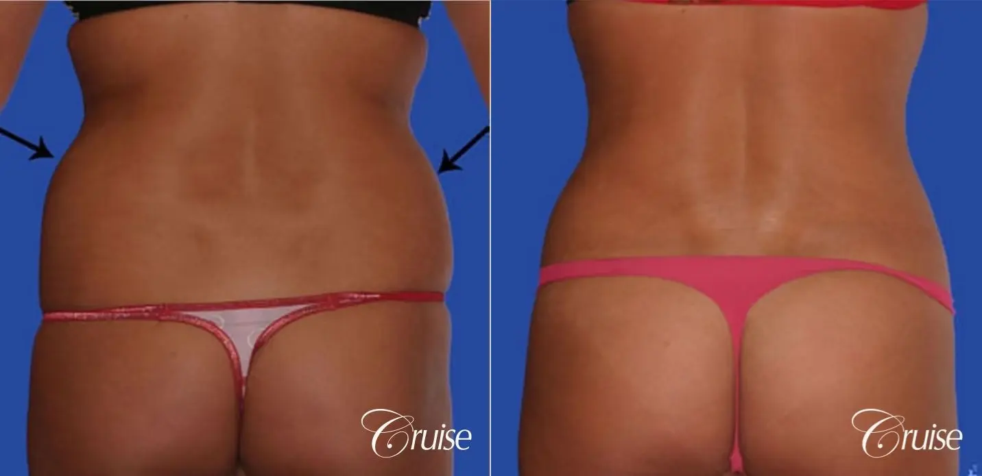 Flank, Back, and Waist Liposuction