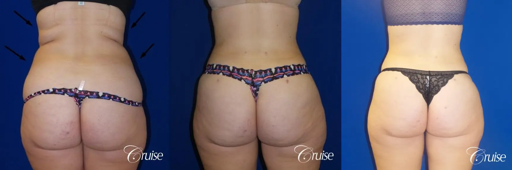Liposuction Flanks & Abdomen - Before and After 2