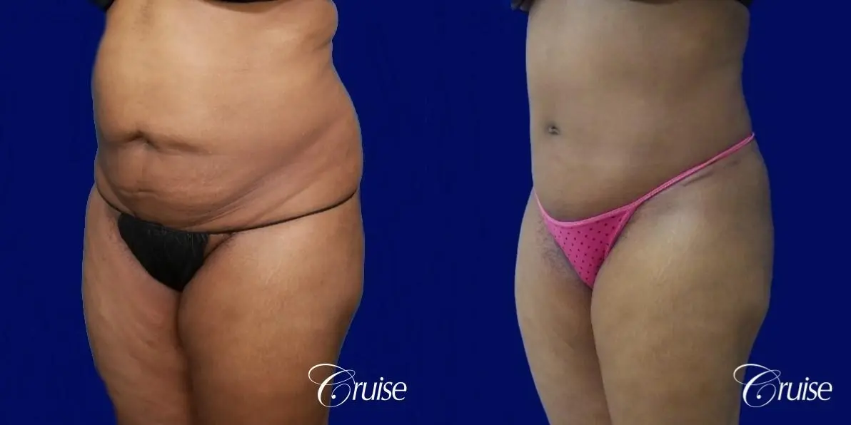 Liposuction Flanks - Before and After 3