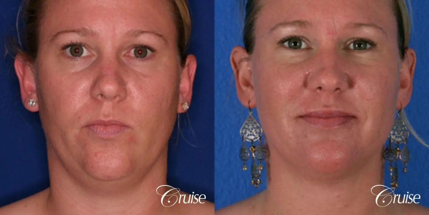 best liposuction neck and jawline for double chin - Before and After 1