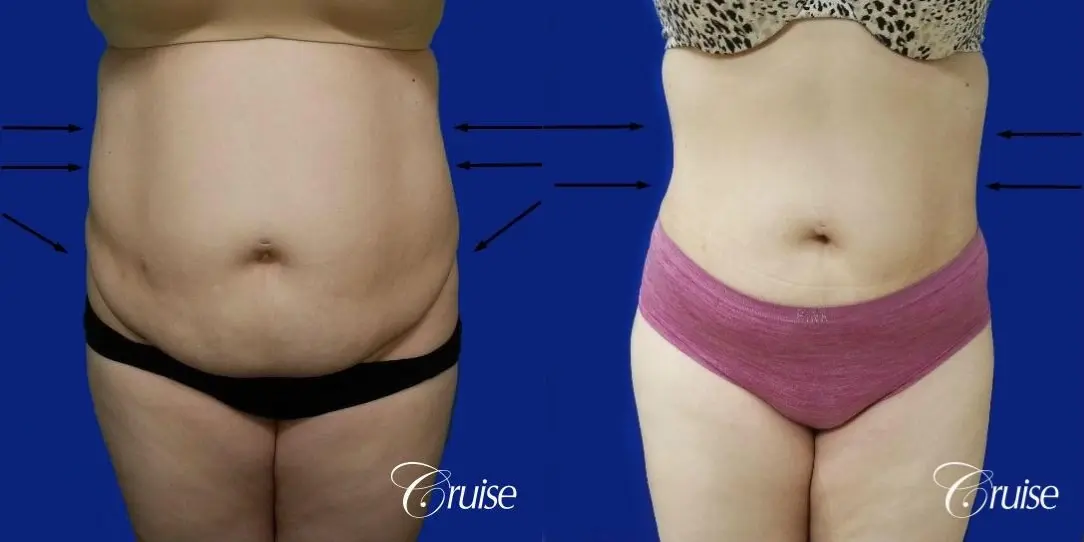 Best liposuction procedures dr cruise - Before and After 1