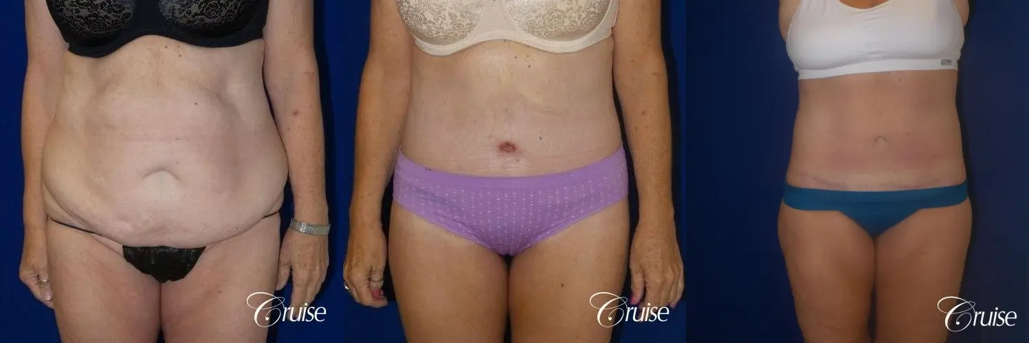 Liposuction with Circumferential Tummy Tuck w/BBL & Liposuction - Before and After 1