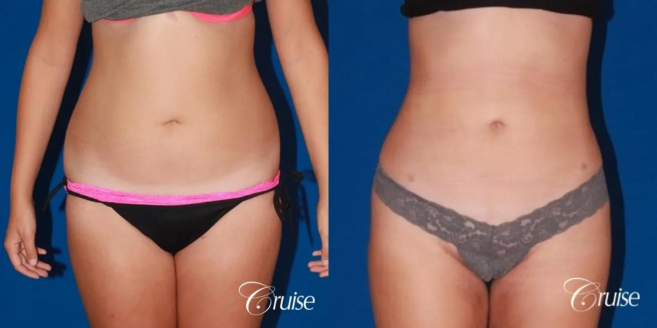 liposuction love handles and tummy - Before and After