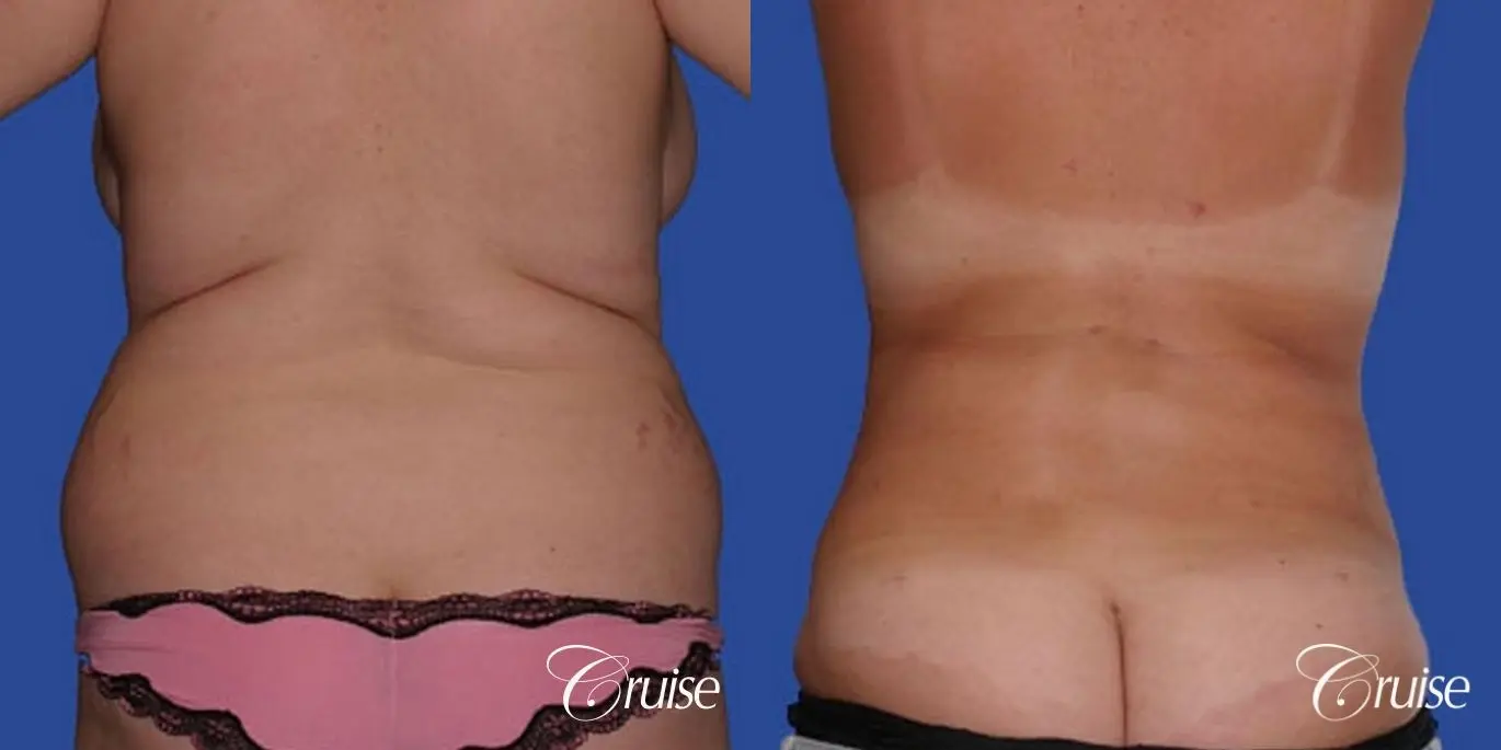 best before and after of liposuction abdomen, flanks, and upper back - Before and After 1