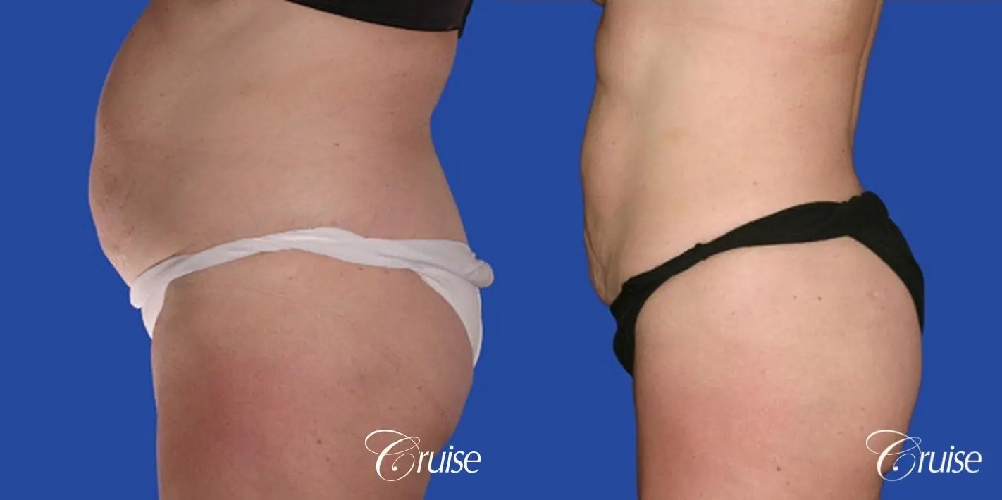 best pictures of liposuction abdomen with skin laxity - Before and After 2