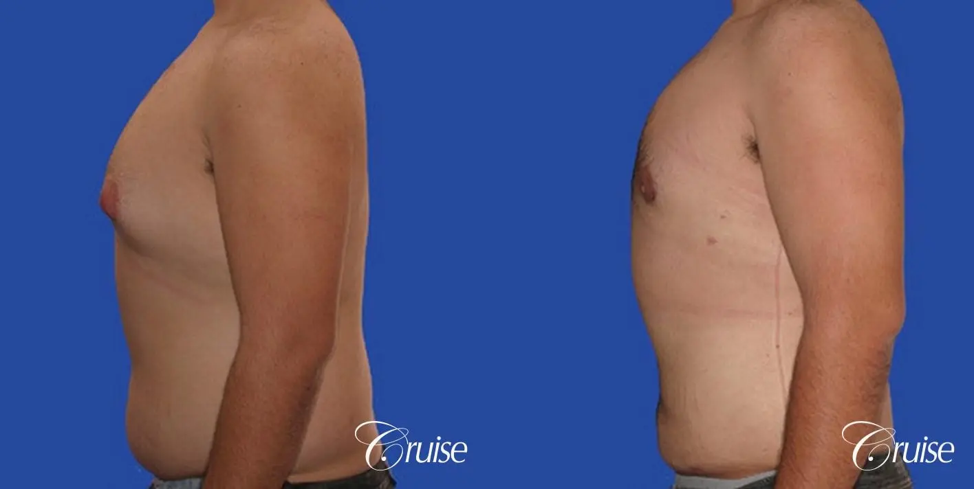 male liposuction abdomen flanks with Gynecomastia - Before and After 4