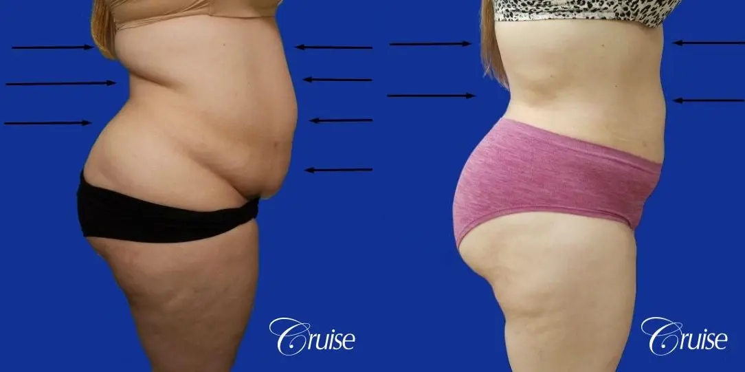 Best liposuction procedures dr cruise - Before and After 4