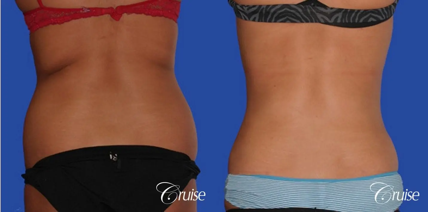 fast way to get with of love handles with liposuction flanks - Before and After 1