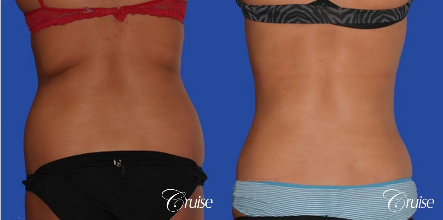 Liposuction of the 'love handles' or flanks