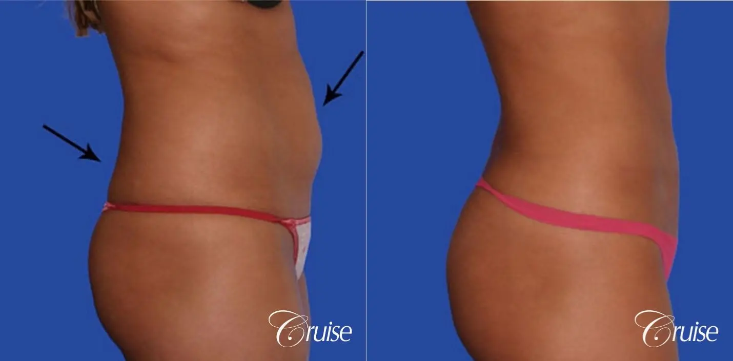 tummy tuck with lipo contouring pictures - Before and After 4