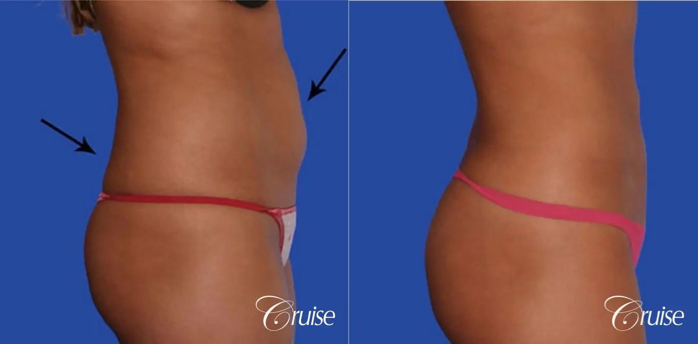 Liposuction - Abdomen / Flanks Before and After Photo Gallery, Coeur  d'Alene, ID