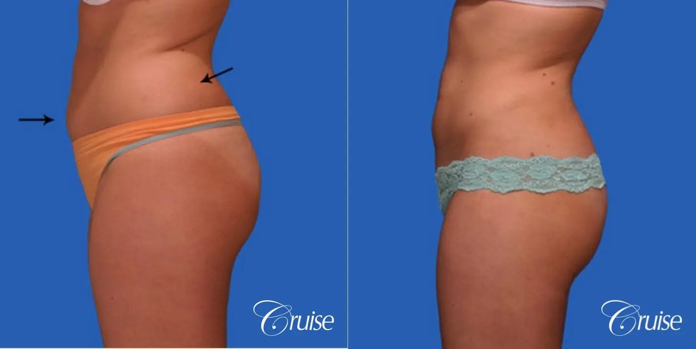 best liposuction results on abdomen, flanks, thighs - Before and After 3