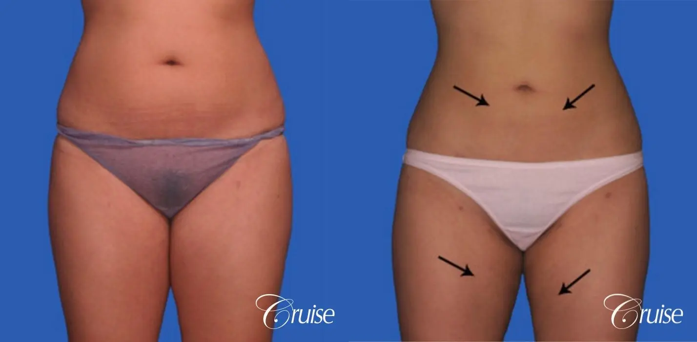 best before and after liposuction stomach and love handles - Before and After 1