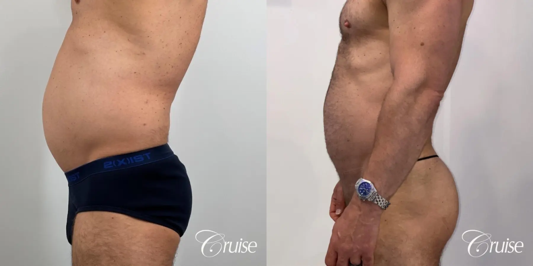 Liposuction: Patient 55 - Before and After 5