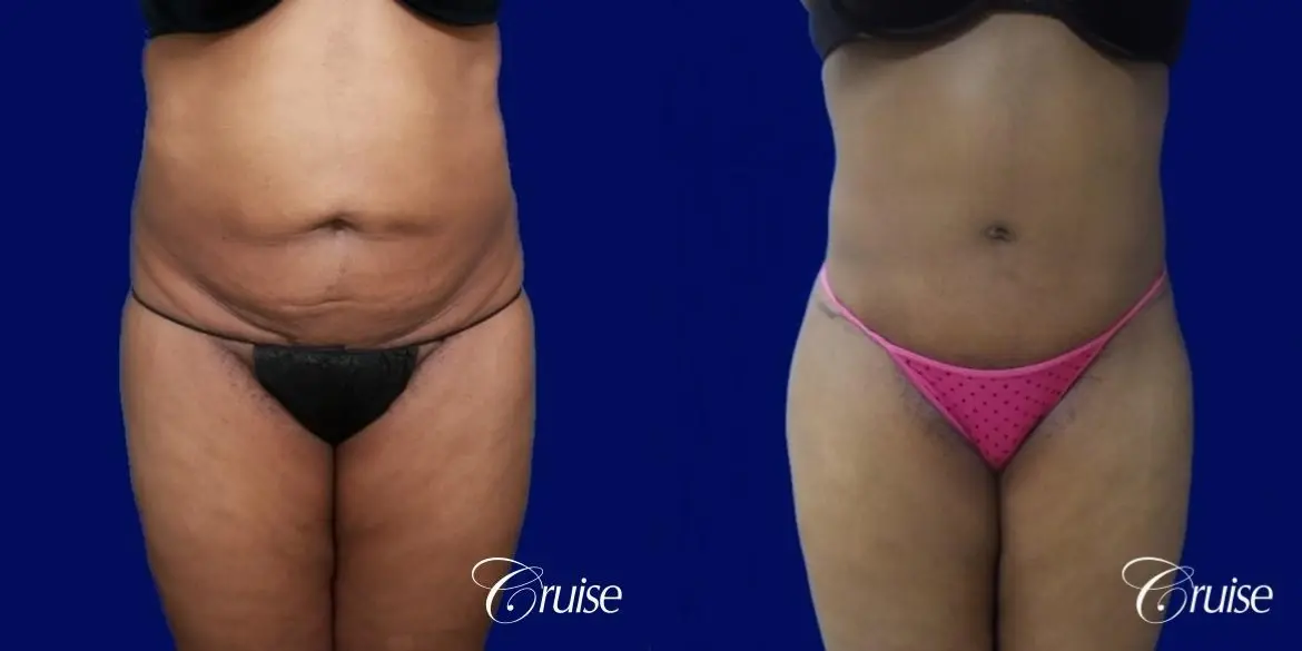 Liposuction Flanks - Before and After 1