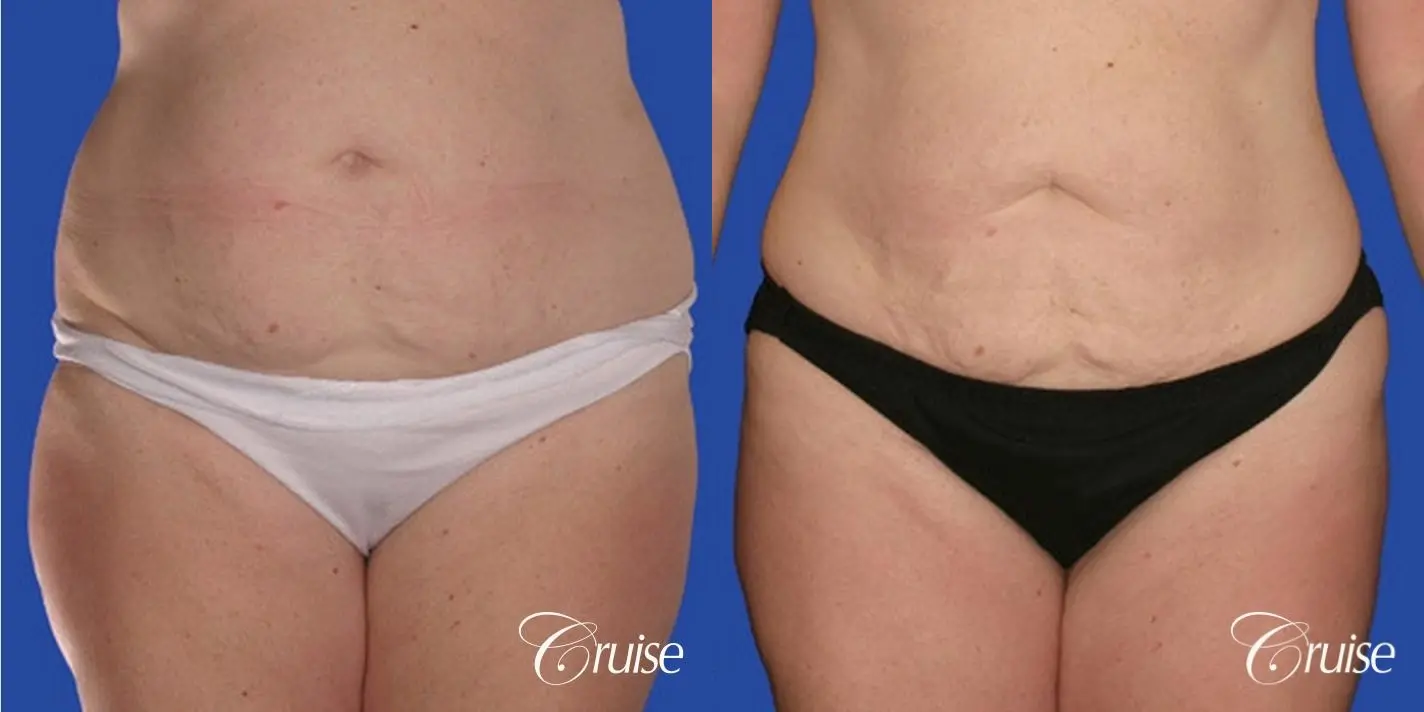 best pictures of liposuction abdomen with skin laxity - Before and After 3