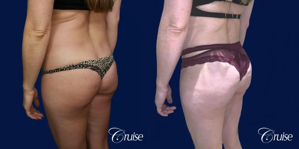 Liposuction - Before and After 3