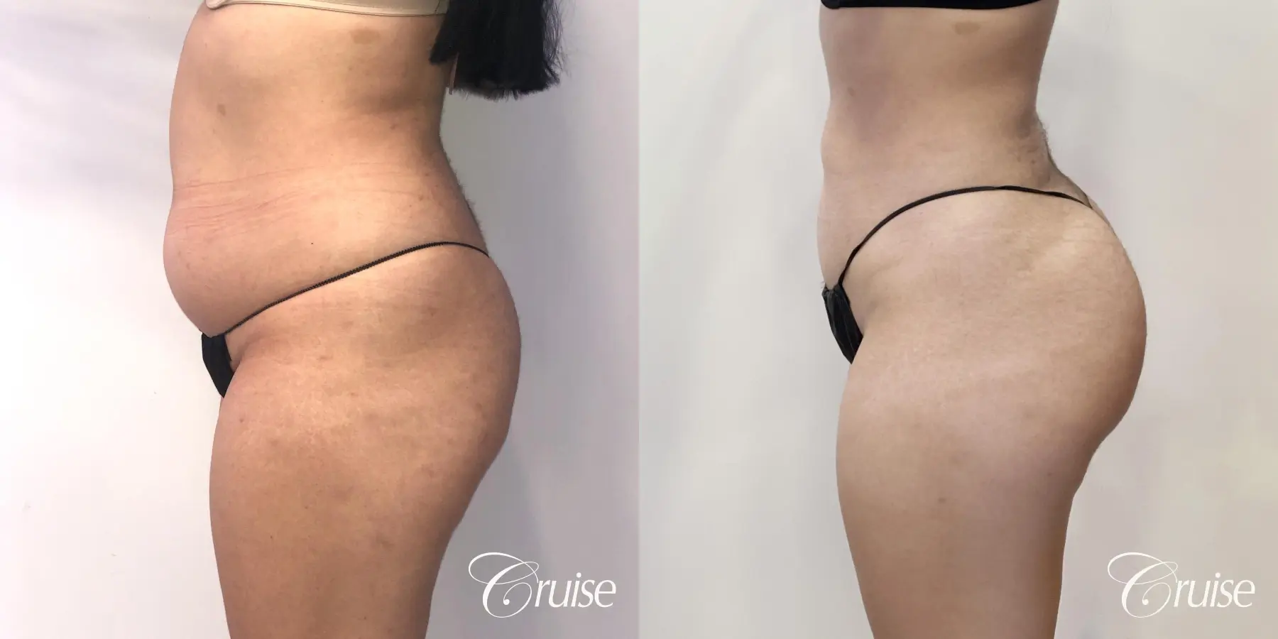 Liposuction: Patient 54 - Before and After 3