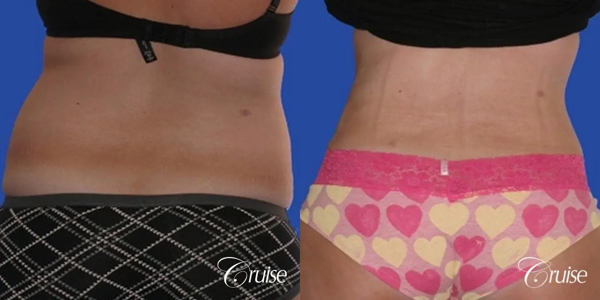 Liposuction: Patient 27 - Before and After 3