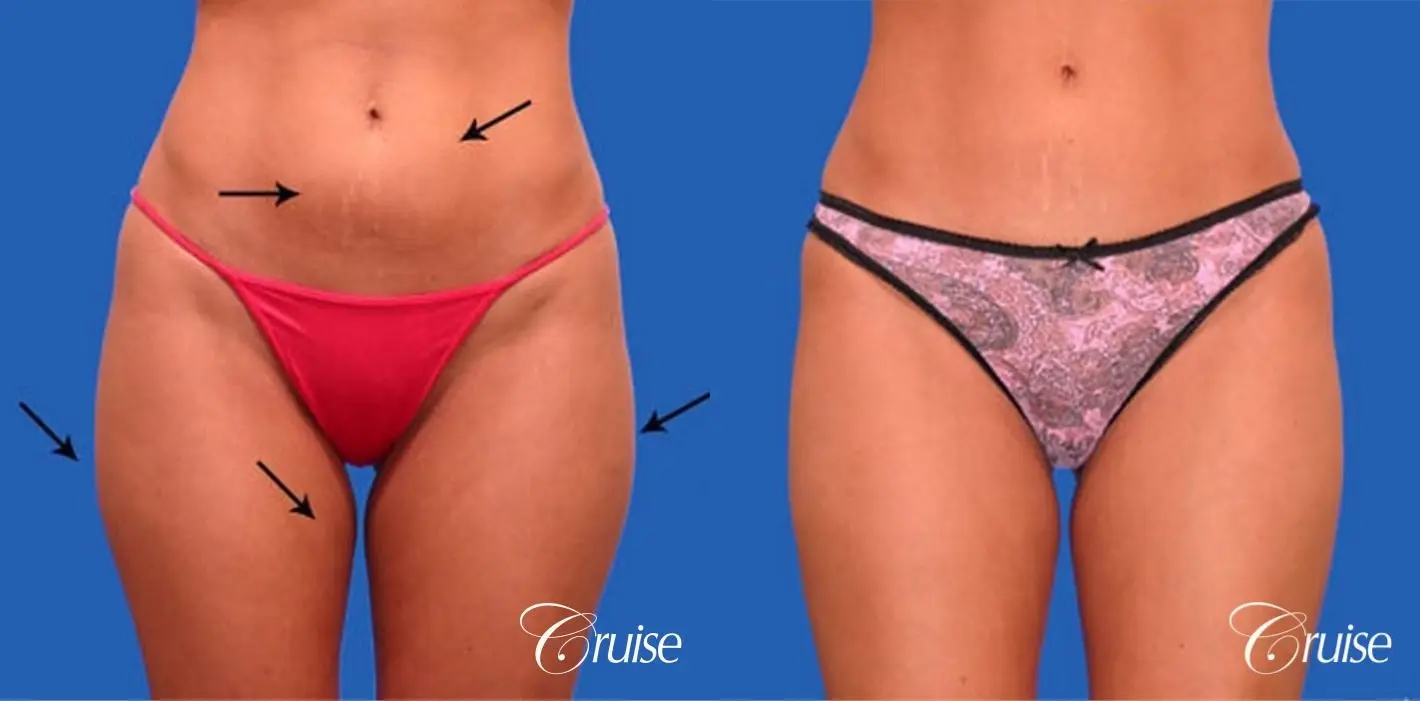 best tummy tuck with liposuction thighs - Before and After 1