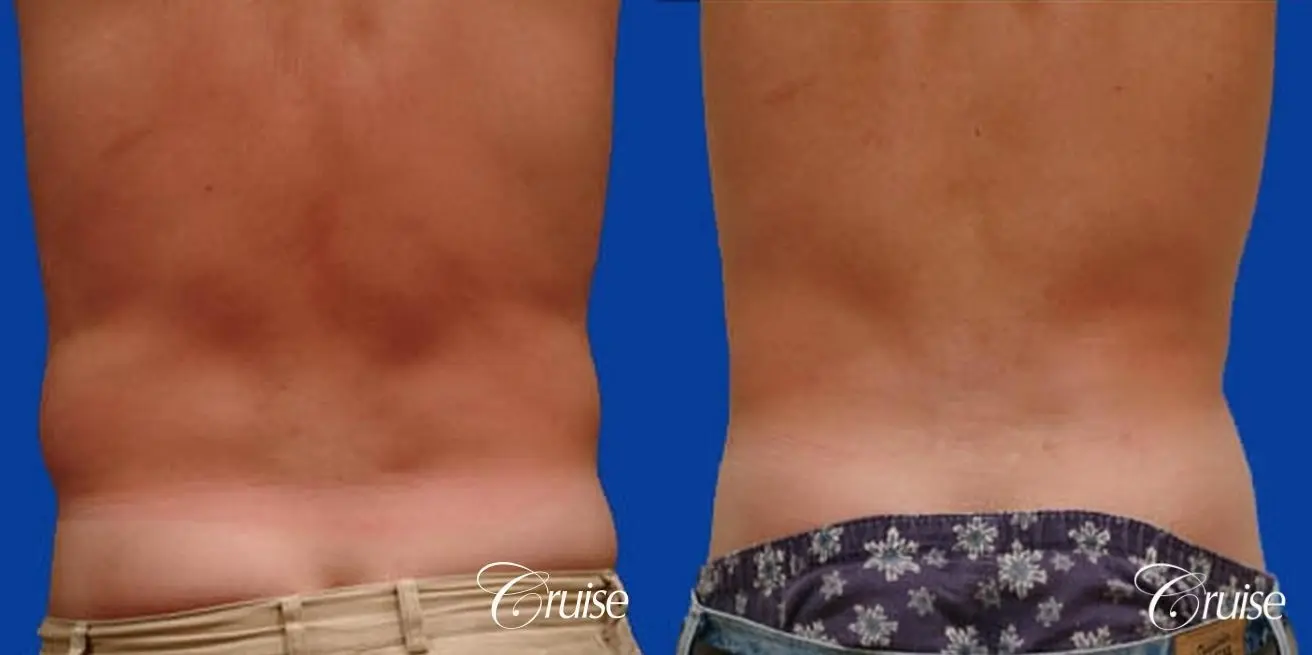 best male ab sculpting liposuction abdomen flanks - Before and After 3