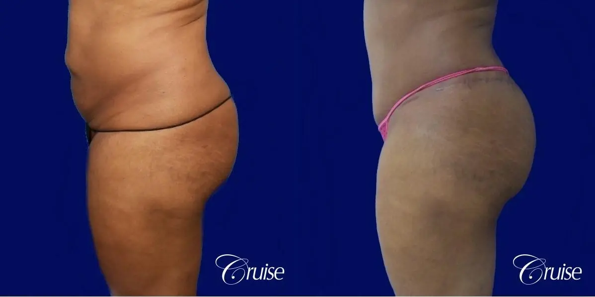 Liposuction Flanks - Before and After 2