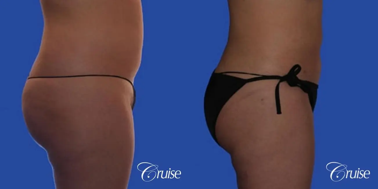 best full body liposuction abdomen flanks thighs knees - Before and After 3