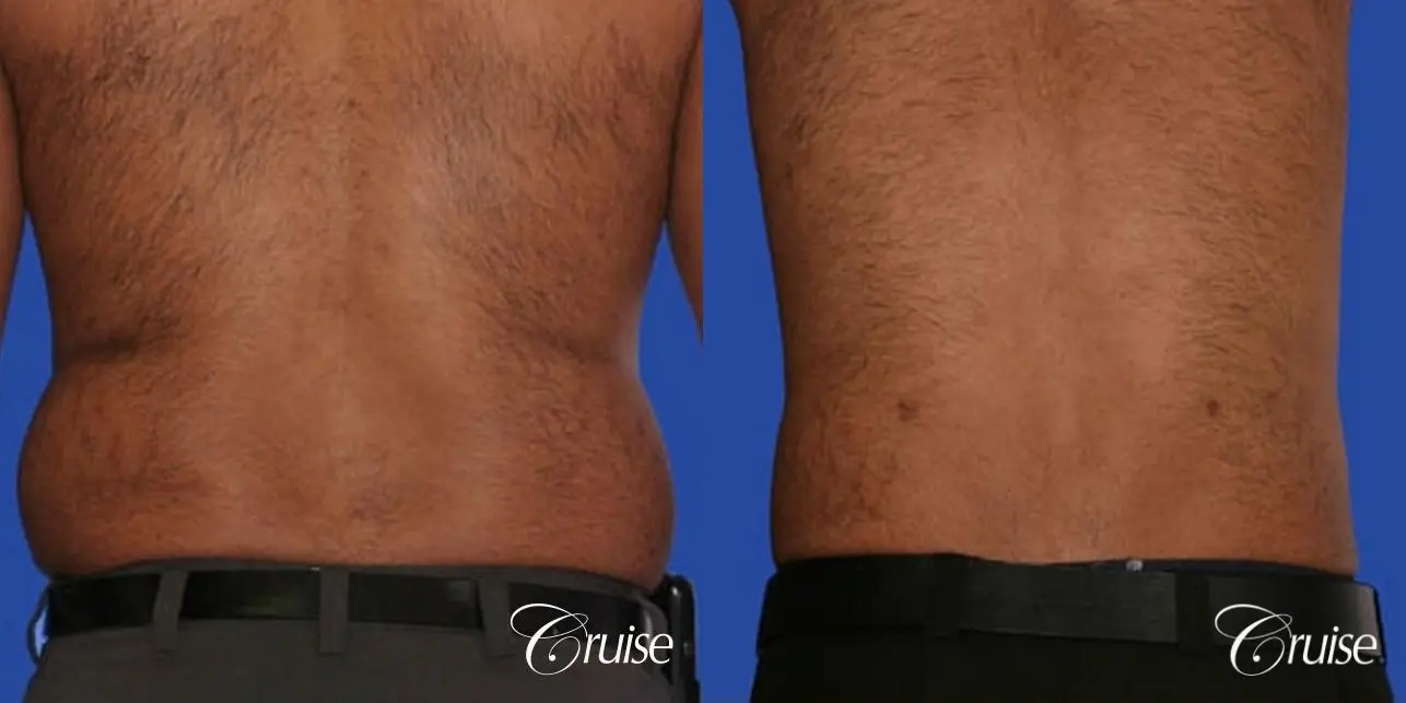 best liposuction abdomen and flanks on a male patient - Before and After 2