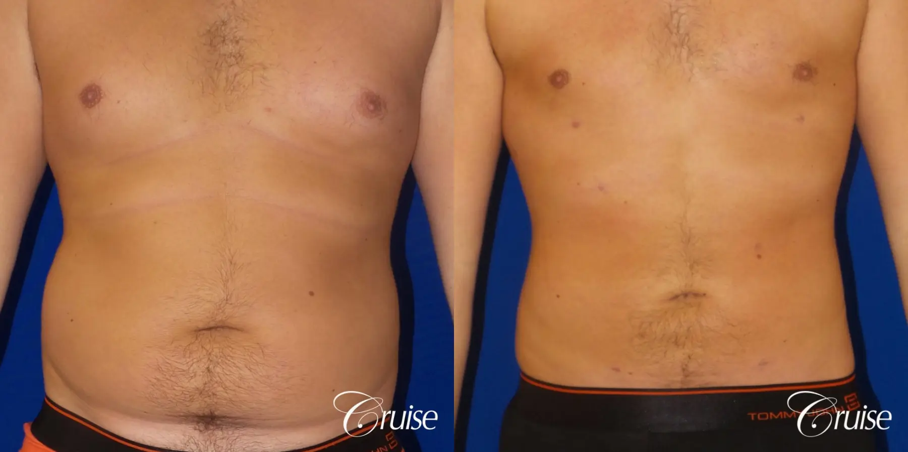 Liposuction: Patient 53 - Before and After 1