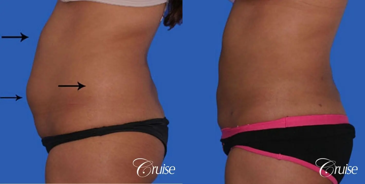 small waist with liposuction abdomen and flanks - Before and After 2