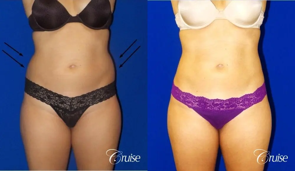 Liposuction -  Flanks - Before and After  