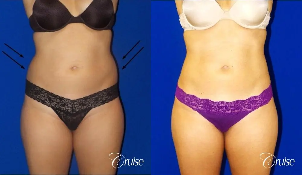 Liposuction -  Flanks - Before and After 1