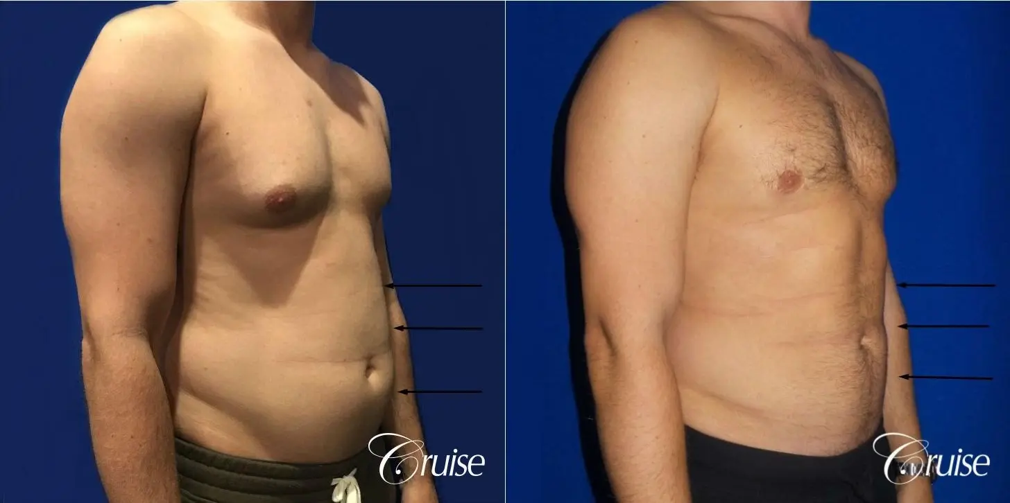 Liposuction Abdomen - Before and After 4