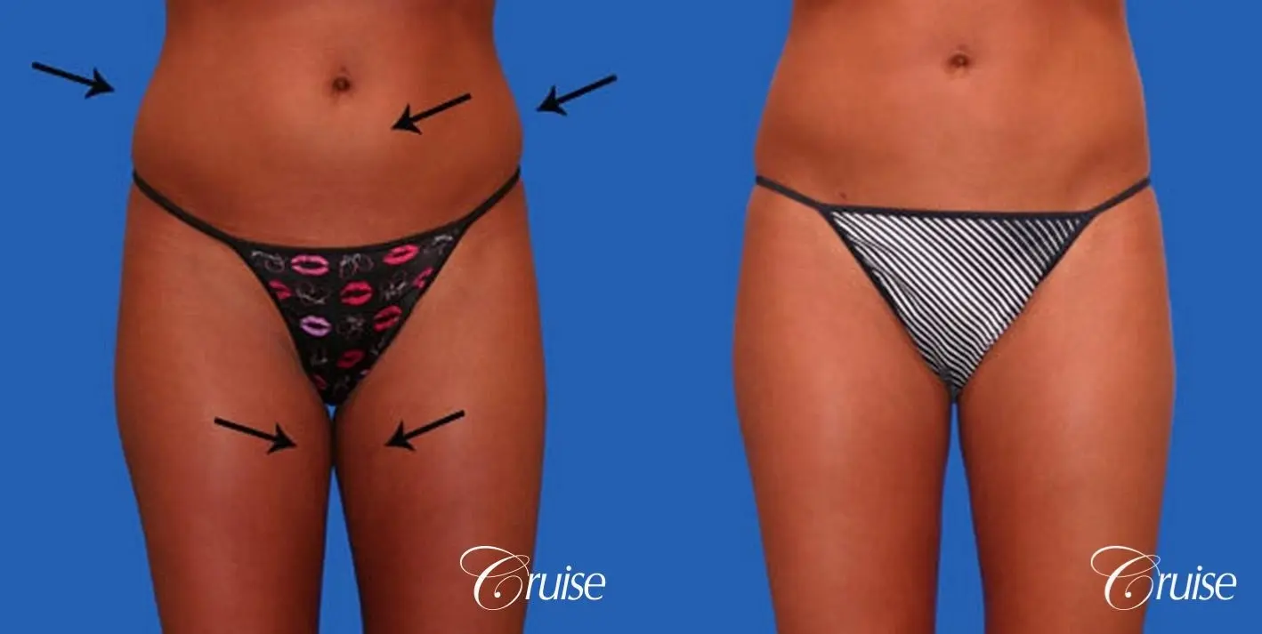 best liposuction abdomen and love handles - Before and After 1