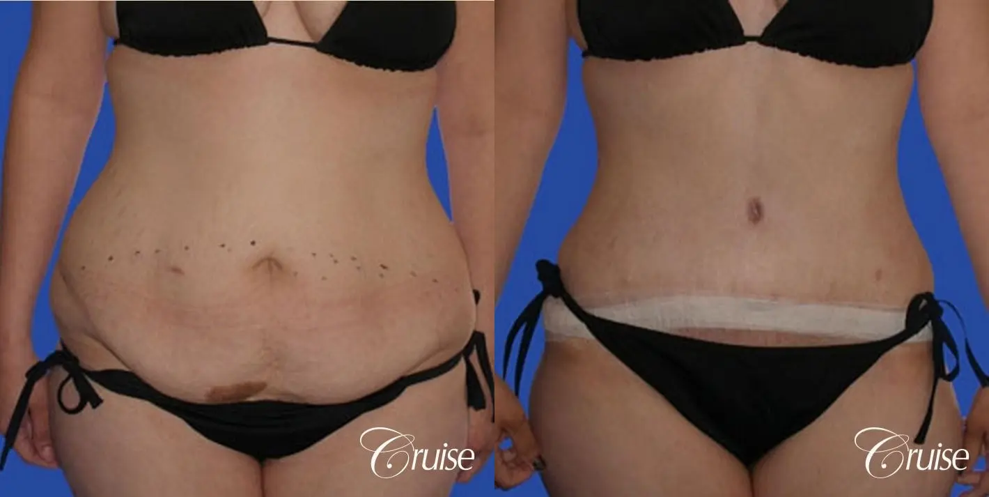 Bra Roll Liposuction in Santa Monica