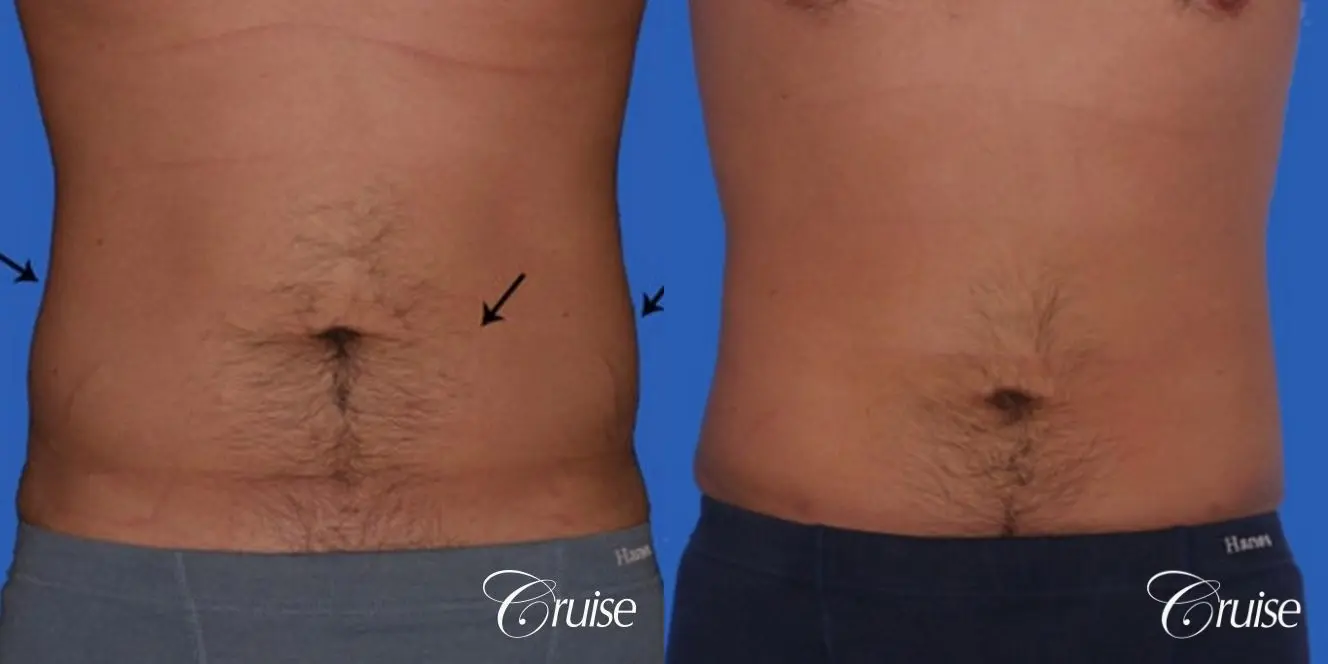 best liposuction to contour a males body - Before and After 1