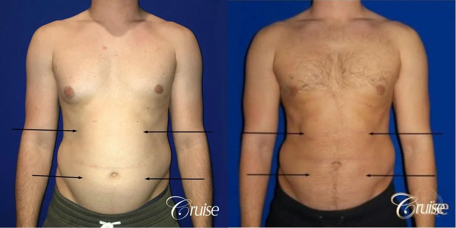 Liposuction Abdomen - Before and After  