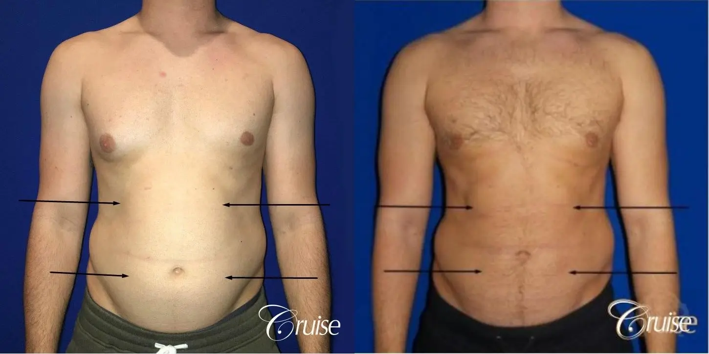 Liposuction Abdomen - Before and After 1