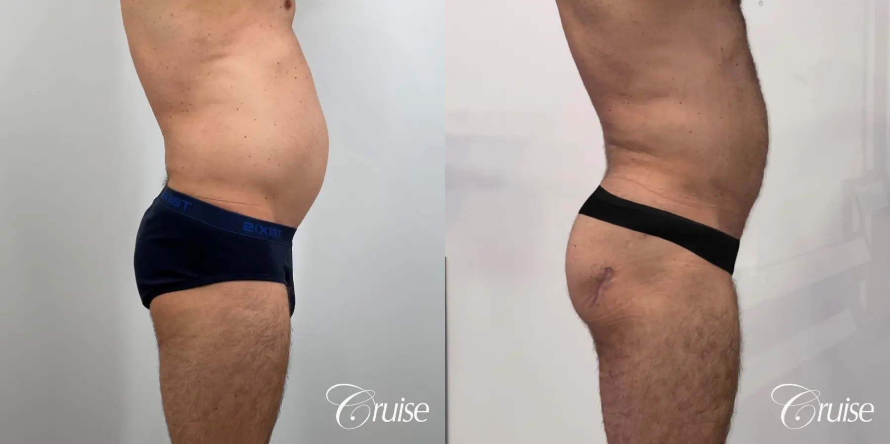 Liposuction: Patient 55 - Before and After 3