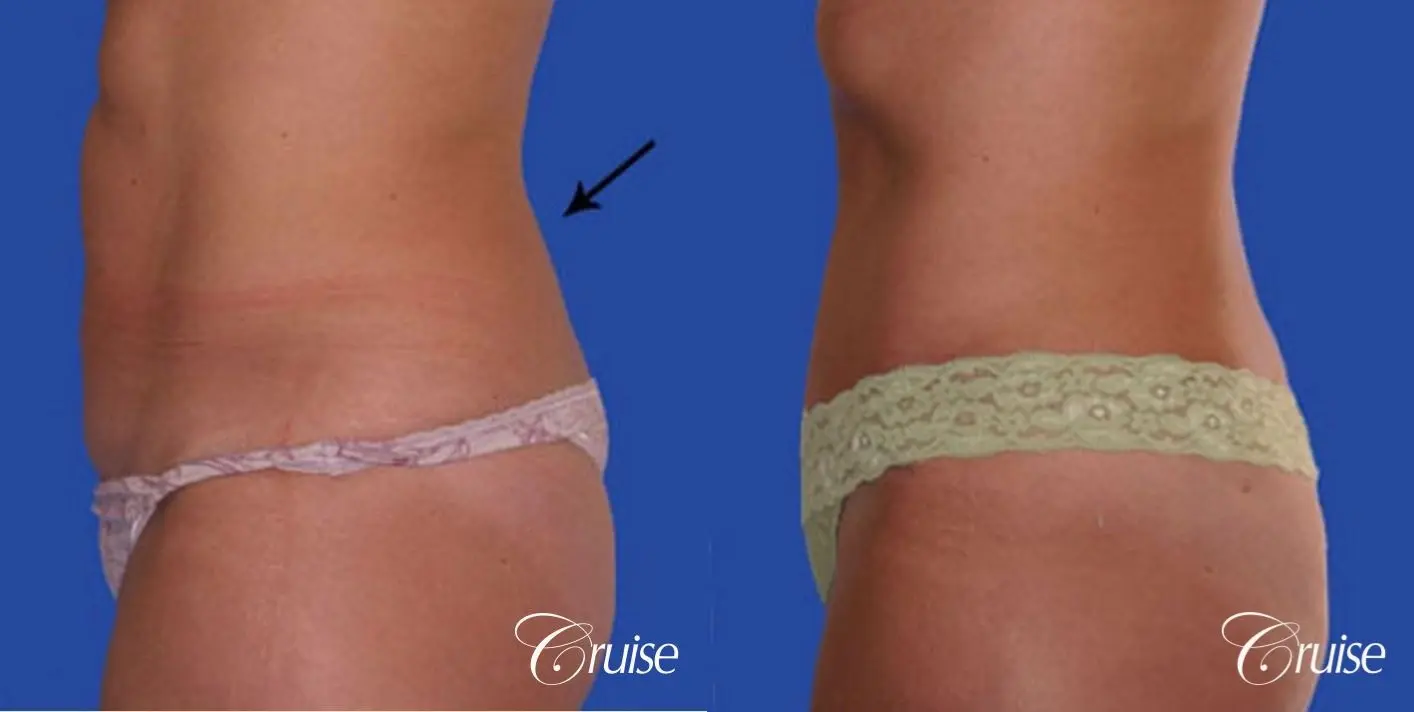 liposuction abdomen flanks with tummy tuck - Before and After 2