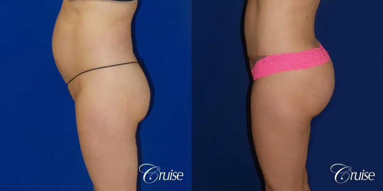 Liposuction - Before and After 2