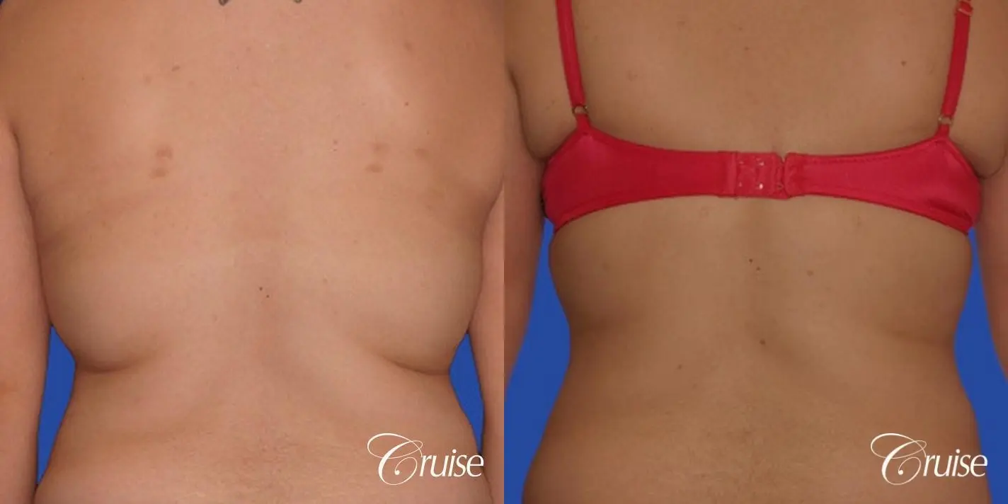 best liposuction pictures of flanks and lipo back - Before and After 1