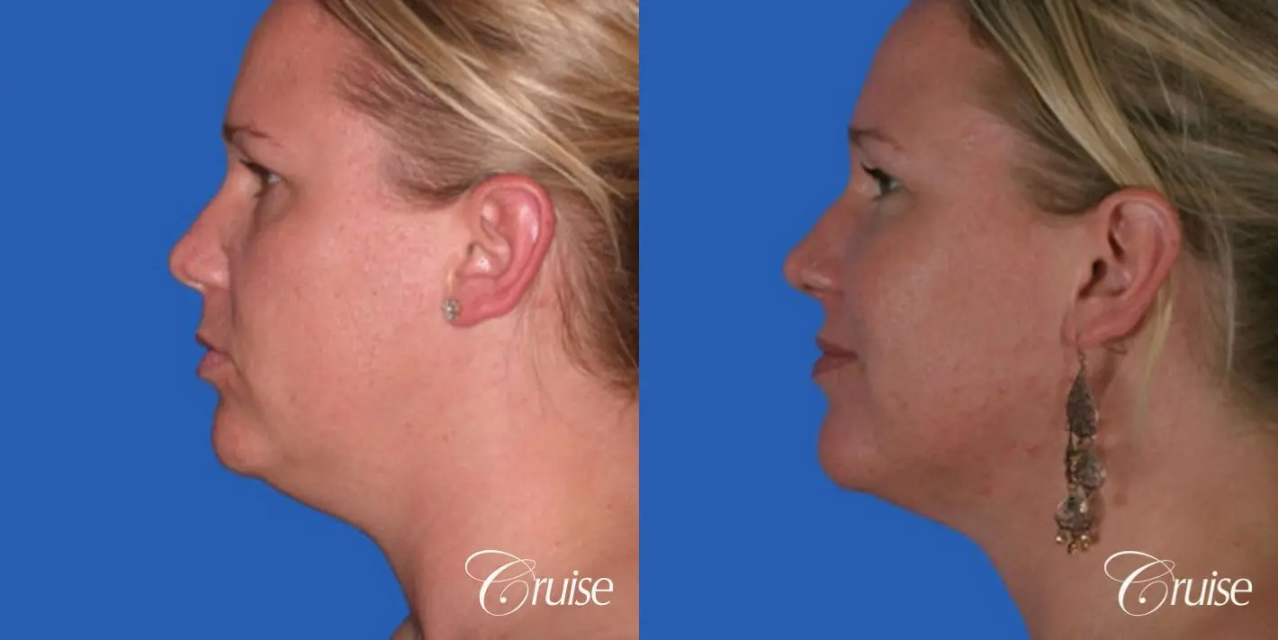 best liposuction neck and jawline for double chin - Before and After 2