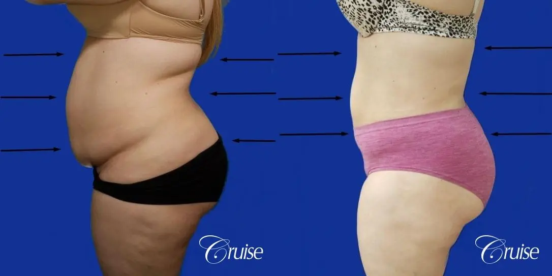 Best liposuction procedures dr cruise - Before and After 2