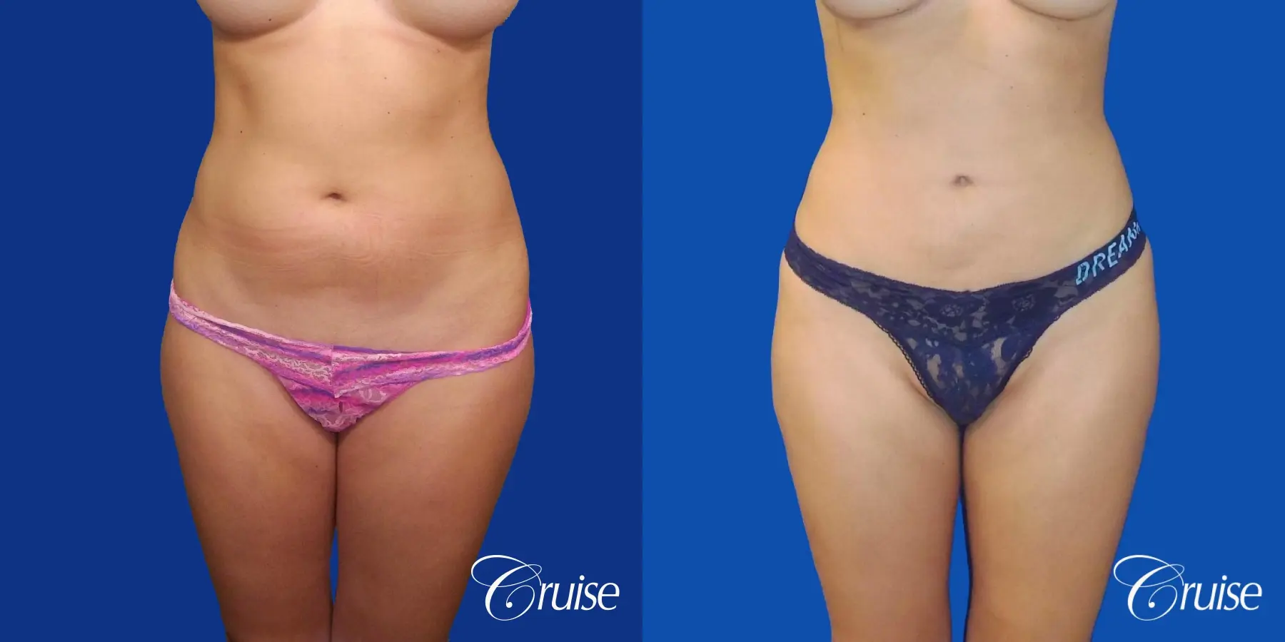 Liposuction - Before and After 1