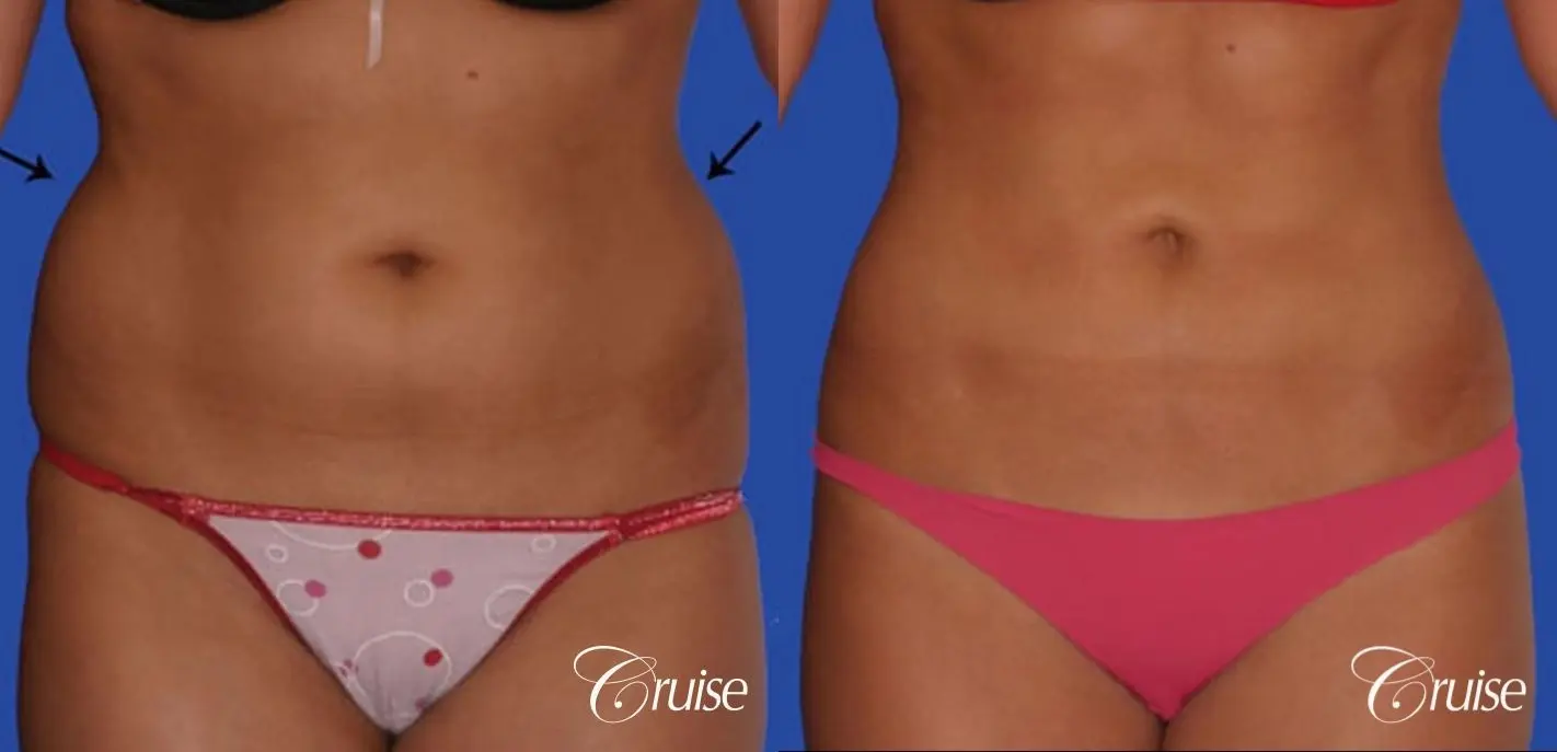 tummy tuck with lipo contouring pictures - Before and After 1