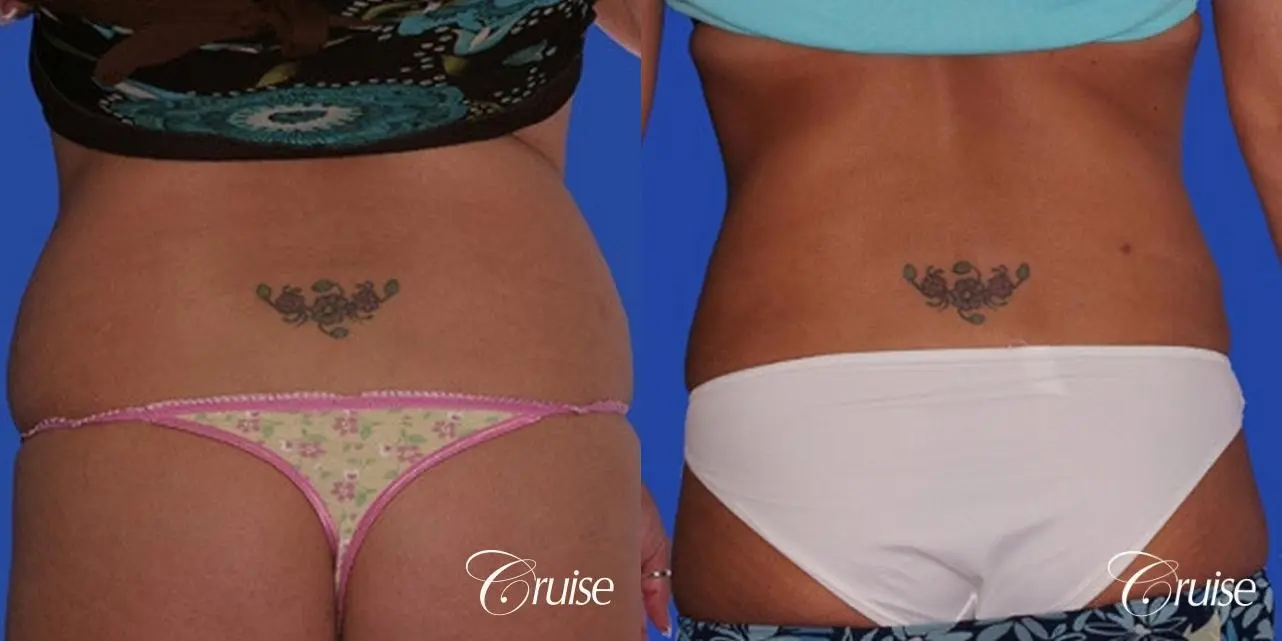 pictures of tummy lipo and lipo muffin top - Before and After 3