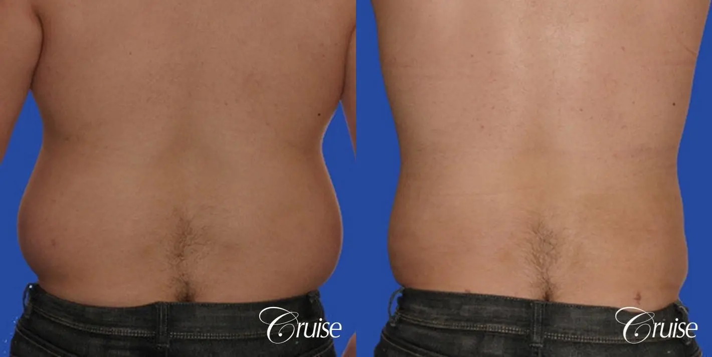 male liposuction abdomen flanks with Gynecomastia - Before and After 2