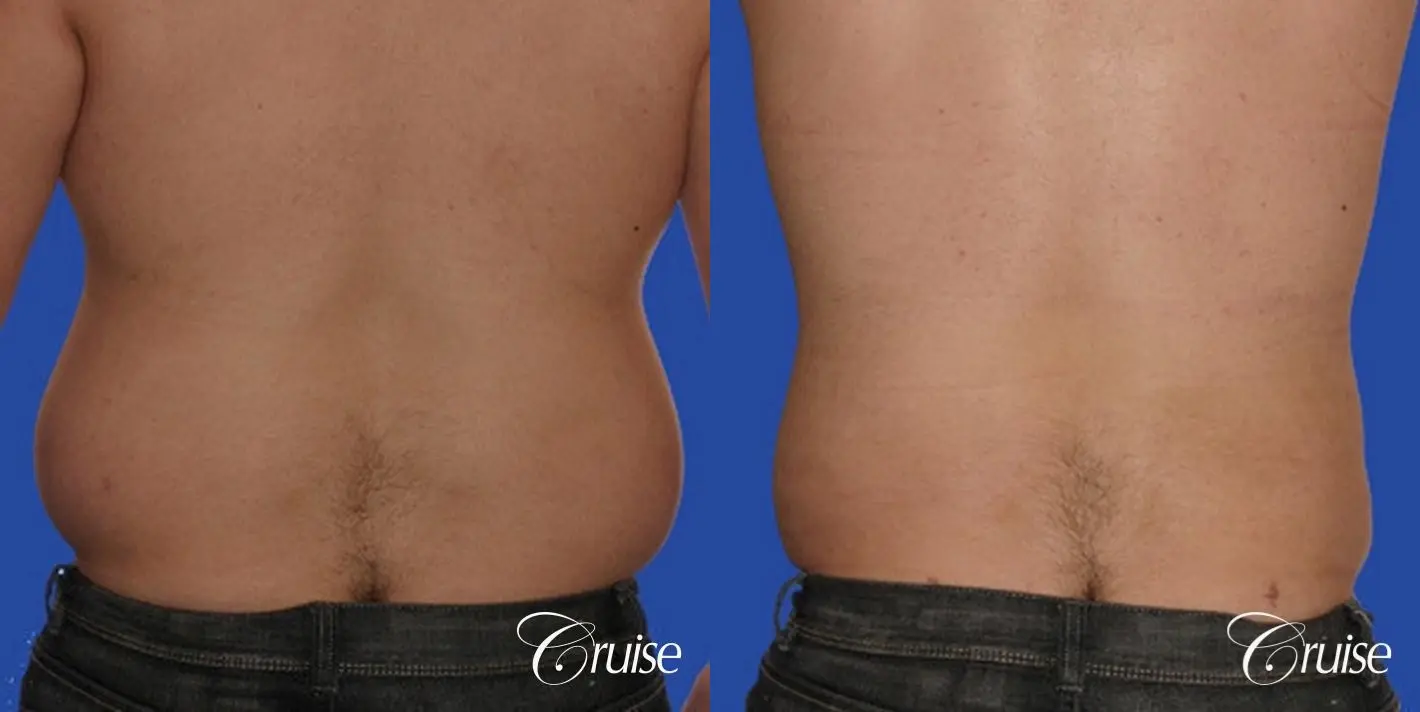 Liposuction for Men Before & After Photos Patient 149