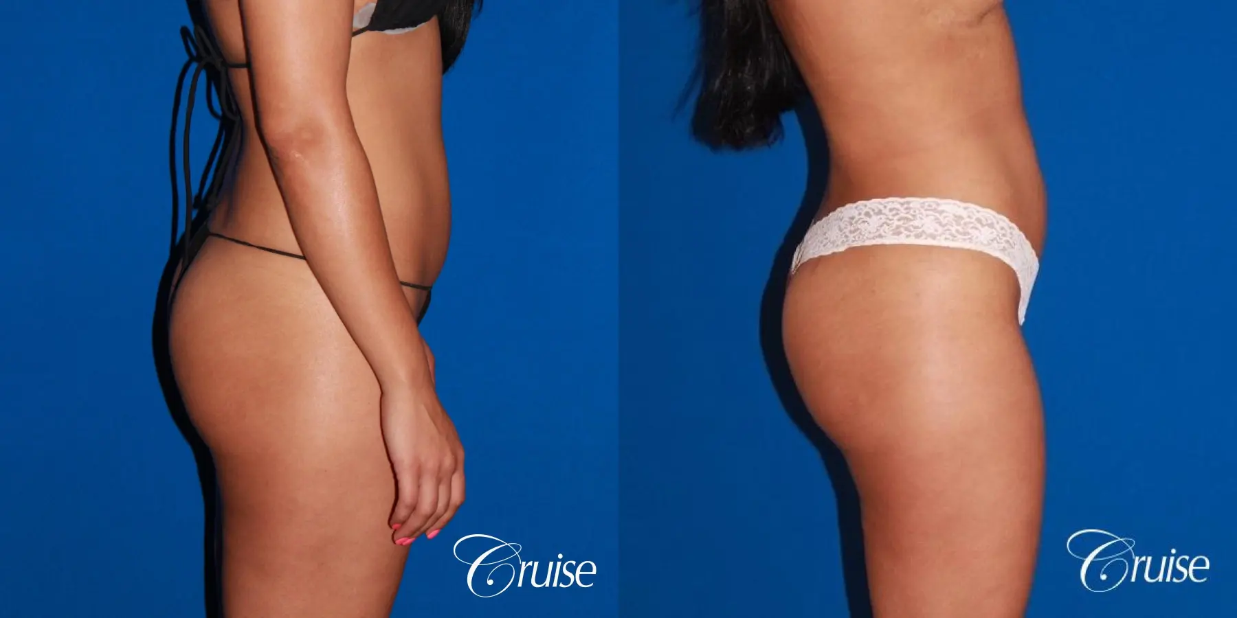 Liposuction Before & After Gallery: Patient 61